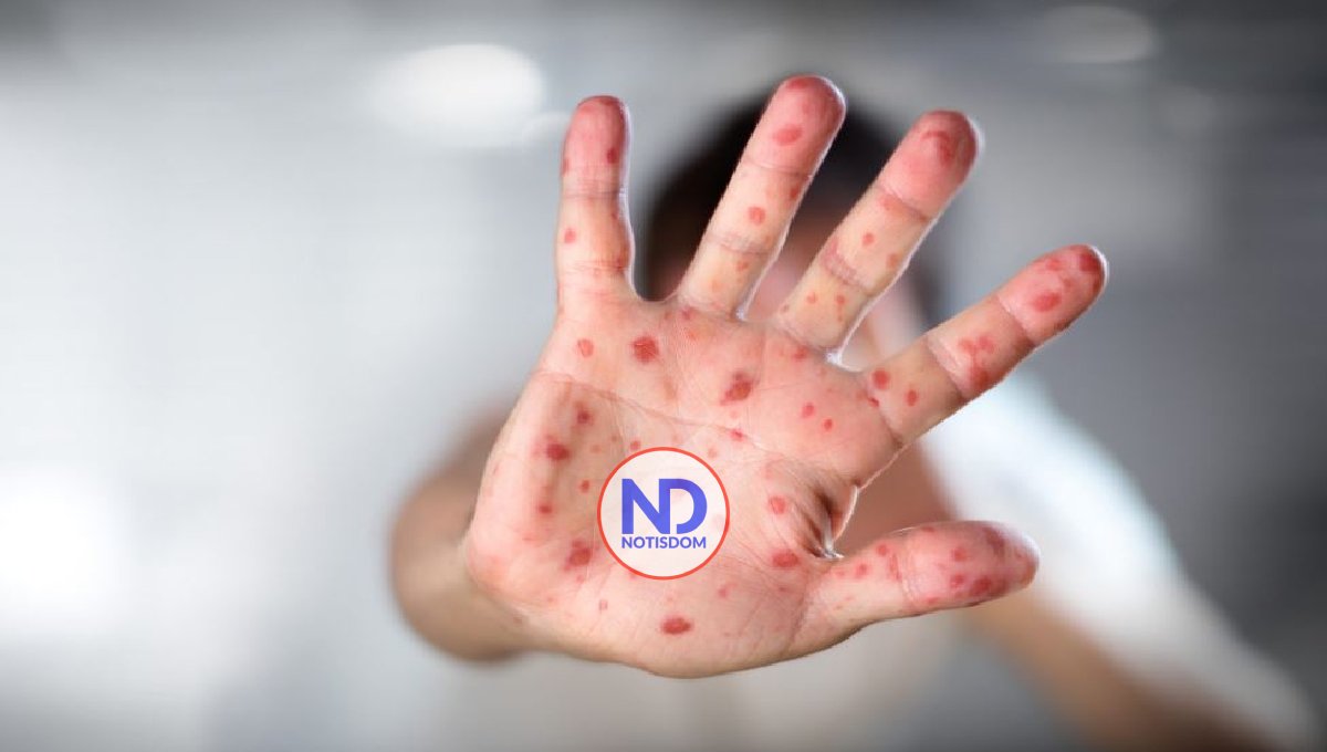 La OMS eleva a 780 los casos globales de viruela del mono