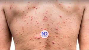 Detectan el primer caso de viruela del mono en Venezuela