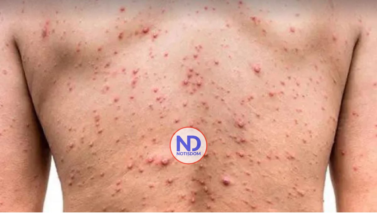 Detectan el primer caso de viruela del mono en Venezuela