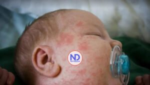 ¿Cómo identificar la Alergia a la Proteína de Leche de Vaca en bebés?