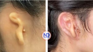 Reconstruyen oreja gracias a tejido humano impreso en 3D