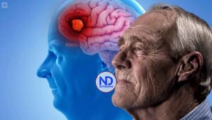 Dos medicamentos ya aprobados frenan síntomas del Alzheimer