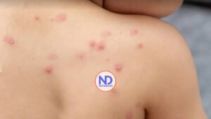 Viruela del Mono: La OMS declara la alerta máxima por aumento de casos