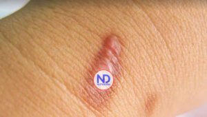 ¿Puedo usar láser para eliminar un queloide en mi hijo de 8 años?