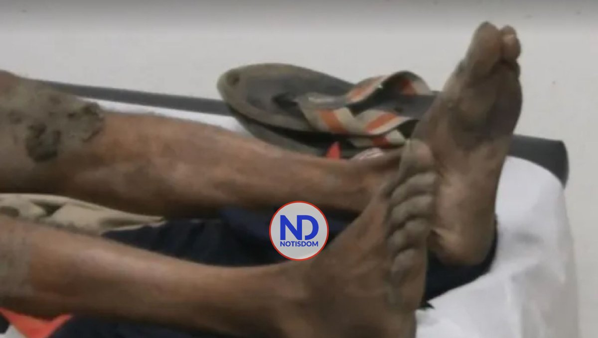 Muere hombre tras ser quemado supuestamente por su esposa 2 Muere hombre tras ser quemado supuestamente por su esposa