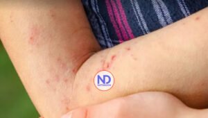 Jamaica confirma su primer caso de viruela del mono