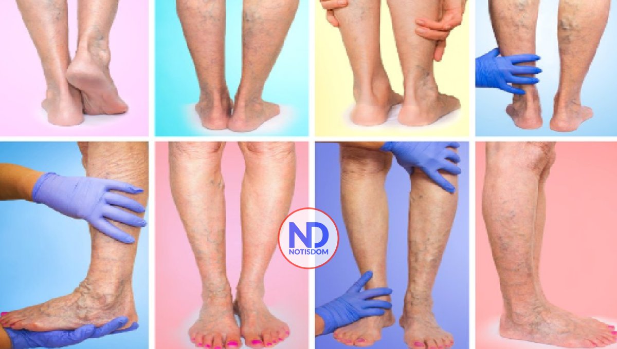 ¿Pueden las venas varicosas causar dolor en la pierna?