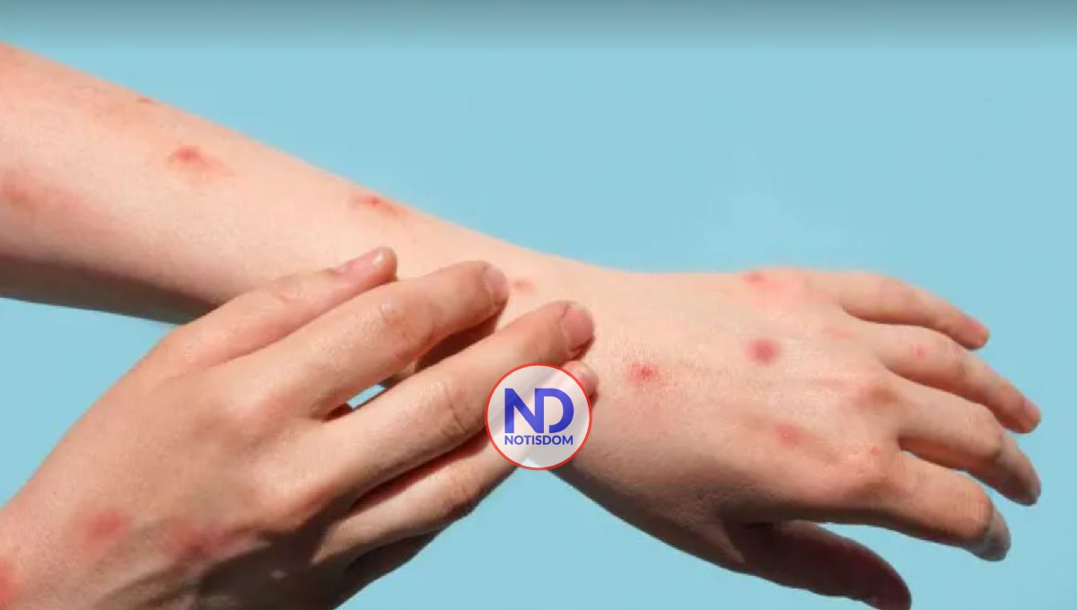 Bahamas confirma un primer caso de viruela del mono y estudia un segundo 2 Bahamas confirma un primer caso de viruela del mono y estudia un segundo