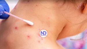 Puerto Rico investiga cuatro posibles casos adicionales de viruela de mono