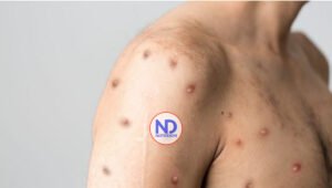 Notifican primer caso sospechoso viruela del mono en Dominicana