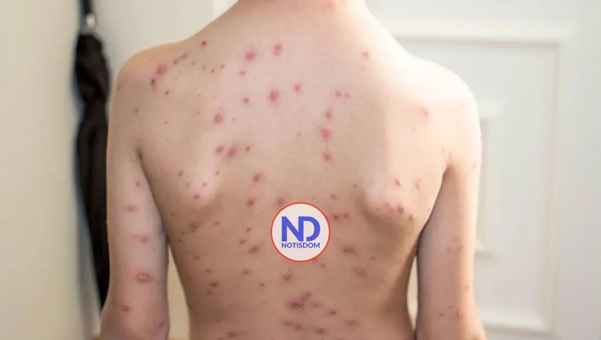 Puerto Rico confirma un segundo caso de viruela del mono