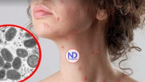 Aumentan a cuatro el total de casos confirmados de viruela del mono en Puerto Rico