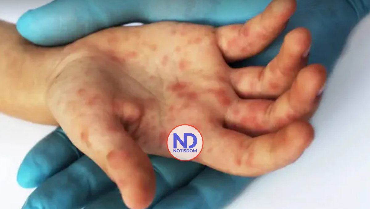 Japón confirma su primer caso de viruela del mono 2 Japón confirma su primer caso de viruela del mono