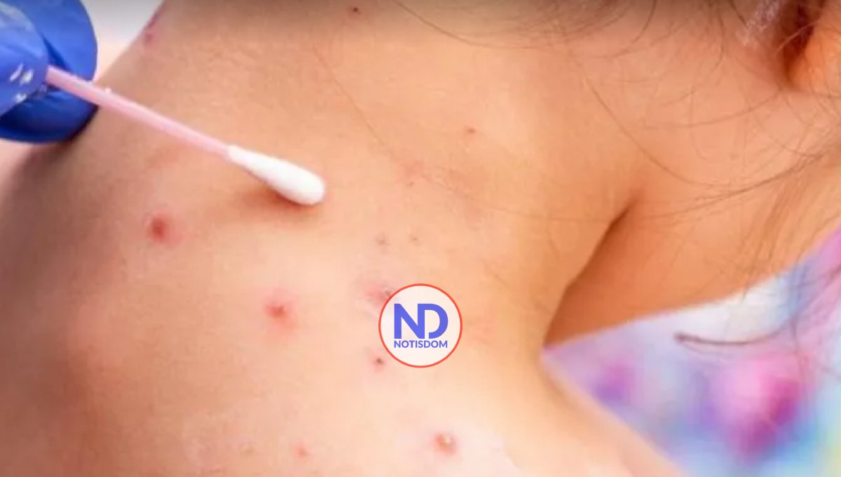 Aumentan a 13 los casos de viruela del mono en Puerto Rico