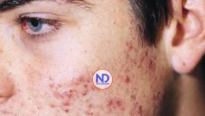 Consejos médicos para el acné y el cuidado diario de nuestra piel