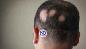 La alopecia, pérdida anormal de cabello que se trata según la causa