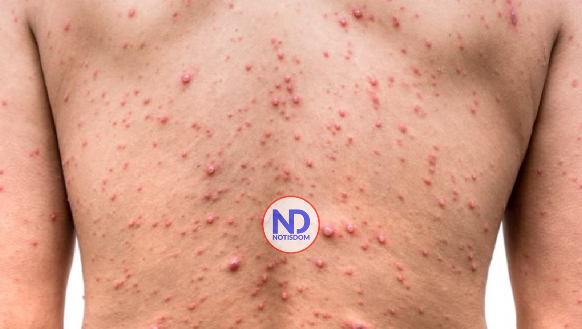 Contacto por la piel es principal vía transmisión viruela símica