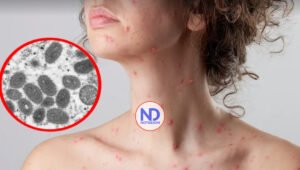 Puerto Rico suma 50 casos de viruela del mono y urge vacunación a LGBTTIQ