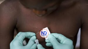 Salud Pública investiga cinco casos sospechosos de viruela del mono