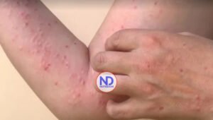 OMS rebautiza la viruela del mono como «mpox» para evitar estigmatización