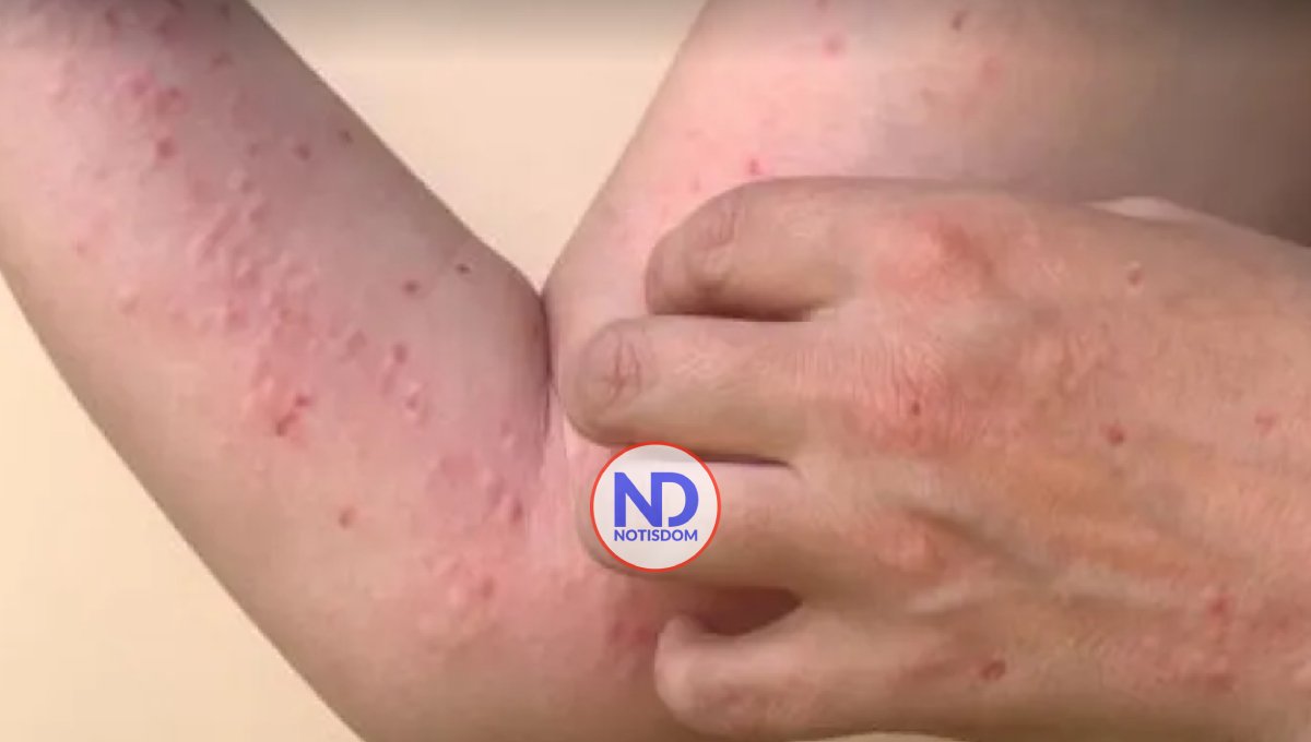 OMS rebautiza la viruela del mono como "mpox" para evitar estigmatización 2 OMS rebautiza la viruela del mono como «mpox» para evitar estigmatización