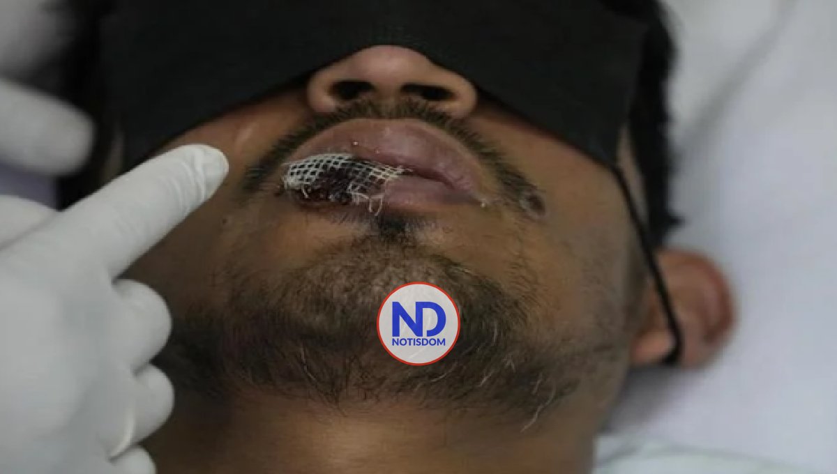 La OPS considera que las Américas es el epicentro de la viruela símica