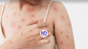 Salud Pública notifica tres nuevos casos de viruela del mono