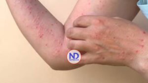 Salud Pública confirma en RD tres nuevos casos de viruela del mono