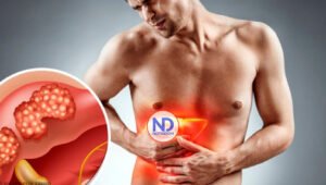 Casos y muertes por cáncer de hígado aumentarán 55% a 2040