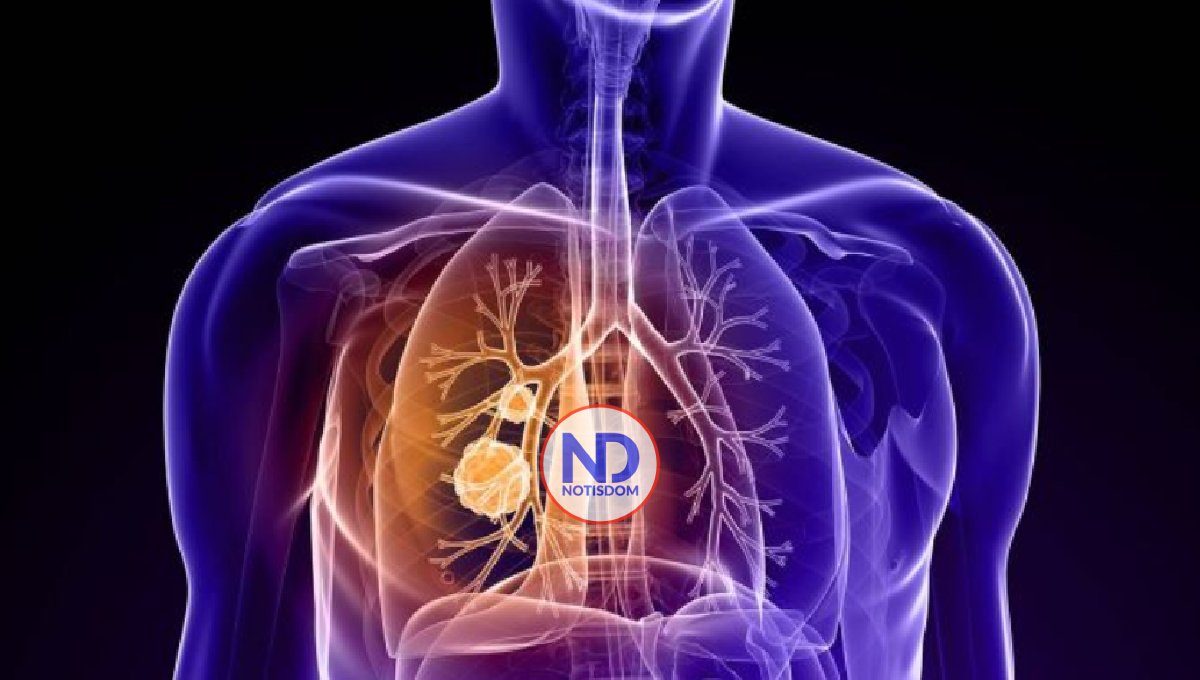 En Latinoamérica es tardío el 85% diagnósticos de cáncer de pulmón