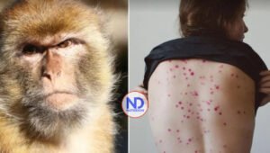 Al menos el 90 % de casos recientes de viruela del mono se han reportado en América