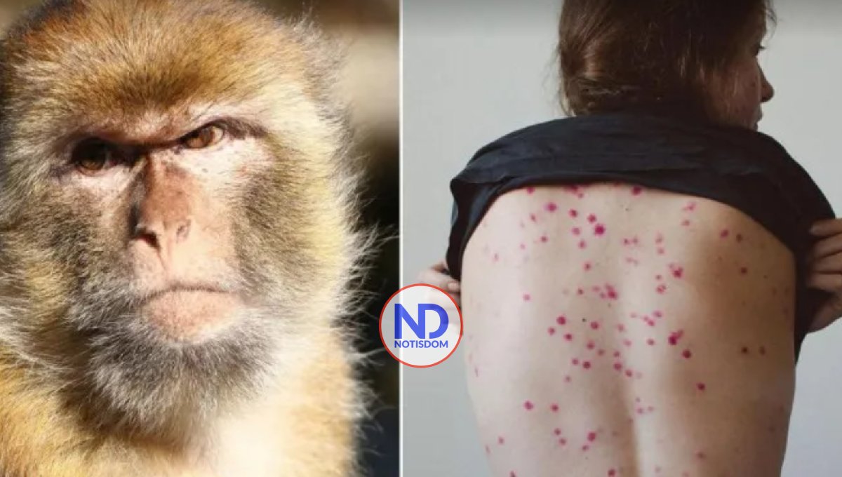 Al menos el 90 % de casos recientes de viruela del mono se han reportado en América