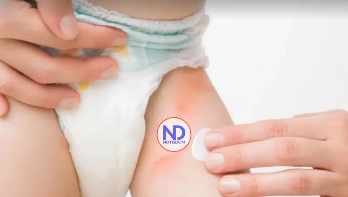 ¿Cómo puede afectar el pañalitis y la no circuncisión en los bebes?