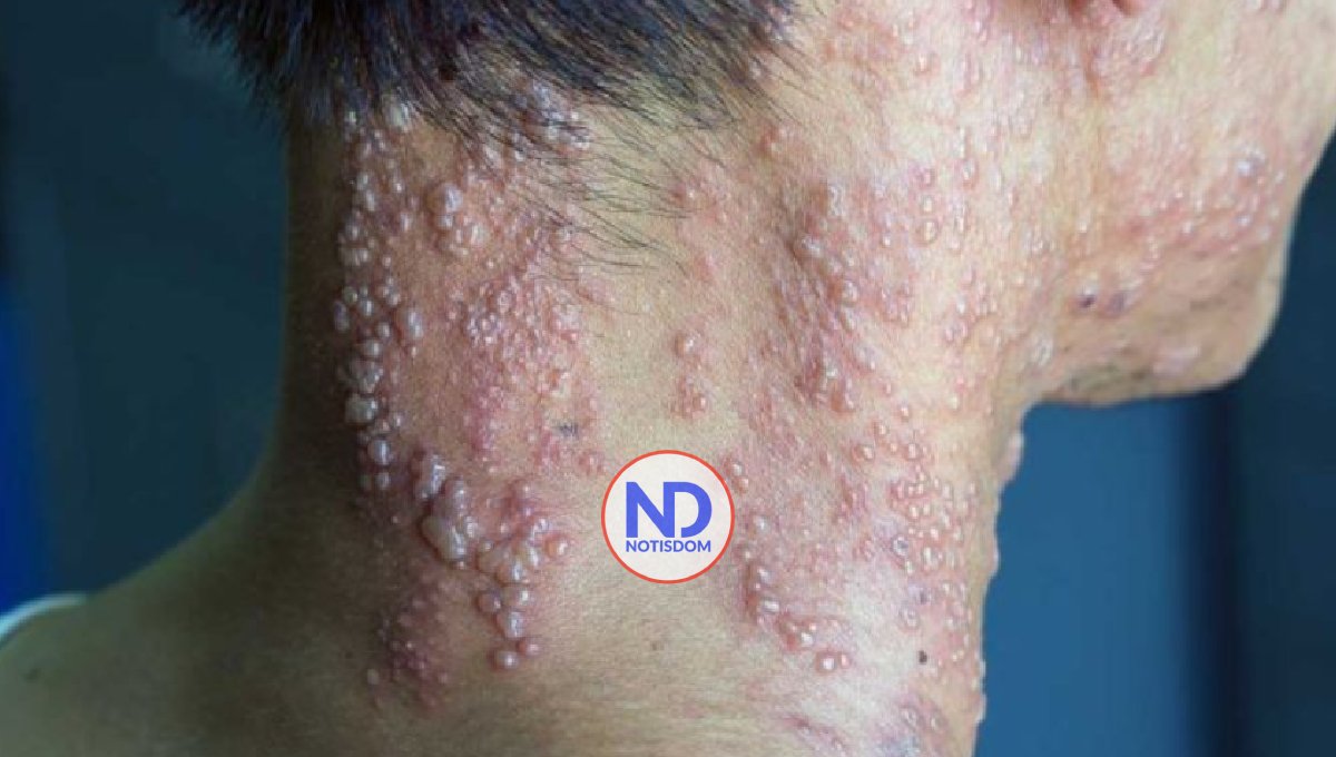 Estudio explica por qué el herpes zóster puede provocar un ictus