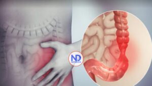 Enfermedad inflamatoria intestinal y síndrome de colon irritable: ¿Son lo mismo?