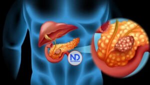 Los avances en el tratamiento contra el cáncer de páncreas brindan opciones y esperanza