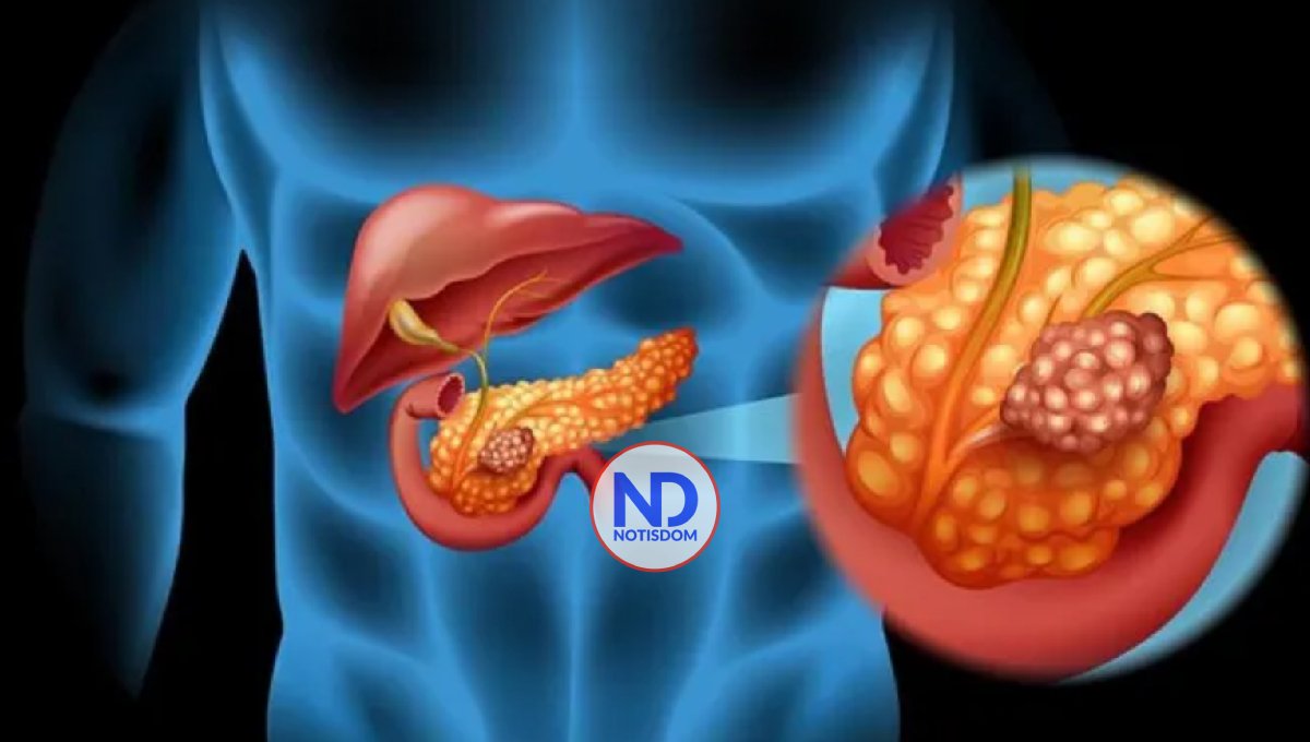 Los avances en el tratamiento contra el cáncer de páncreas brindan opciones y esperanza