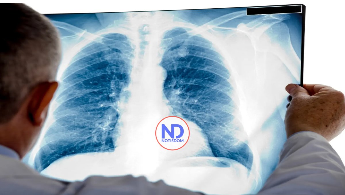 Cáncer de Pulmón: fumar es el principal factor de riesgo