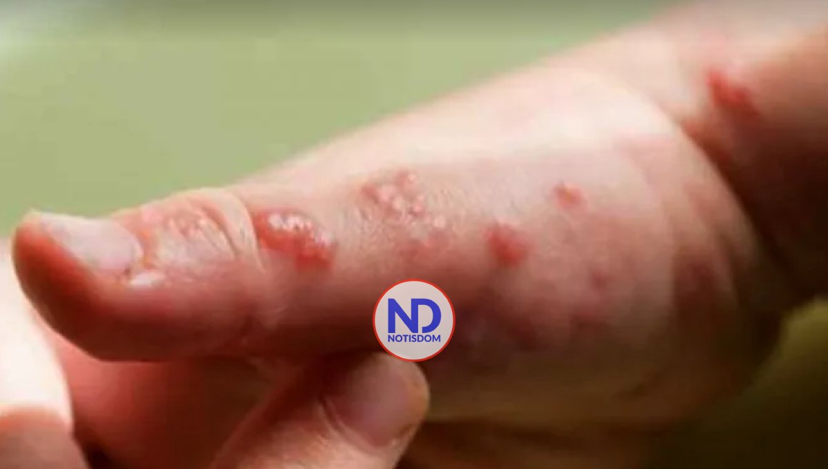 El virus de la viruela del mono podría transmitirse también por vía aérea