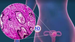 Estudio alerta de alta carga por cáncer de cuello de útero en muchos países