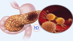 Diseñan unas células T para luchar contra el cáncer de páncreas