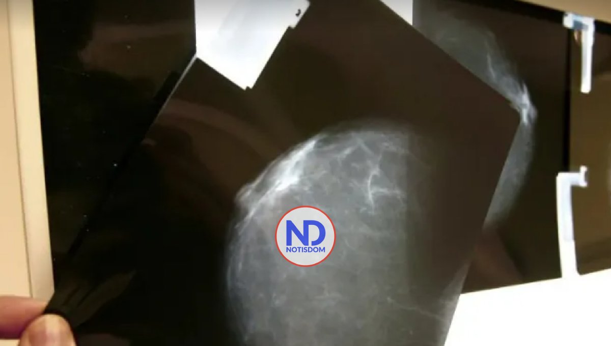 Identifican una nueva diana para el tratamiento del cáncer de mama 2 Identifican una nueva diana para el tratamiento del cáncer de mama