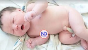 ¿Cuándo se debe operar una hernia umbilical en un bebé?