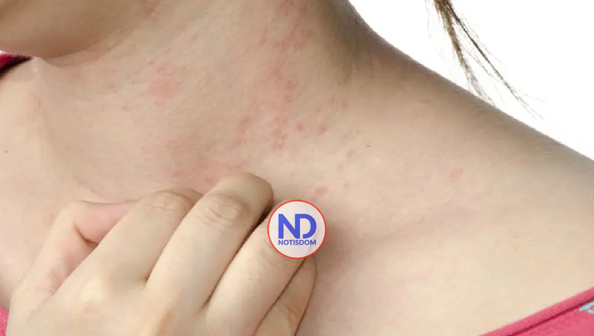 Recomiendan uso de probióticos en diarreas y dermatitis atópicas