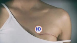 Ejercicios después de la cirugía del cáncer del seno