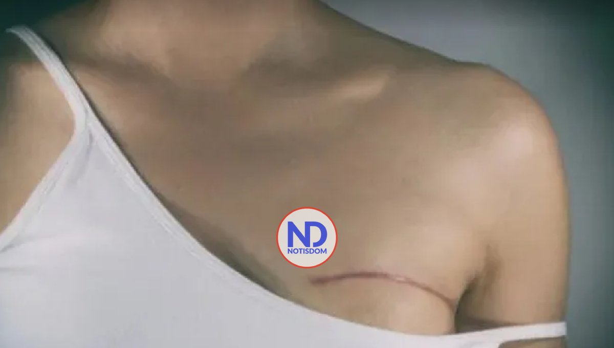 Ejercicios después de la cirugía del cáncer del seno