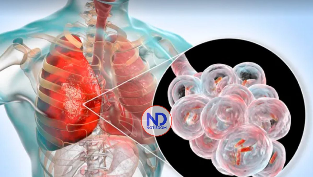 Nueva terapia da esperanza a pacientes con fibrosis pulmonar en México