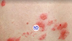 Doctora, tengo herpes simple vaginal, ¿Puedo tomar algún medicamento para prevenir los brotes?