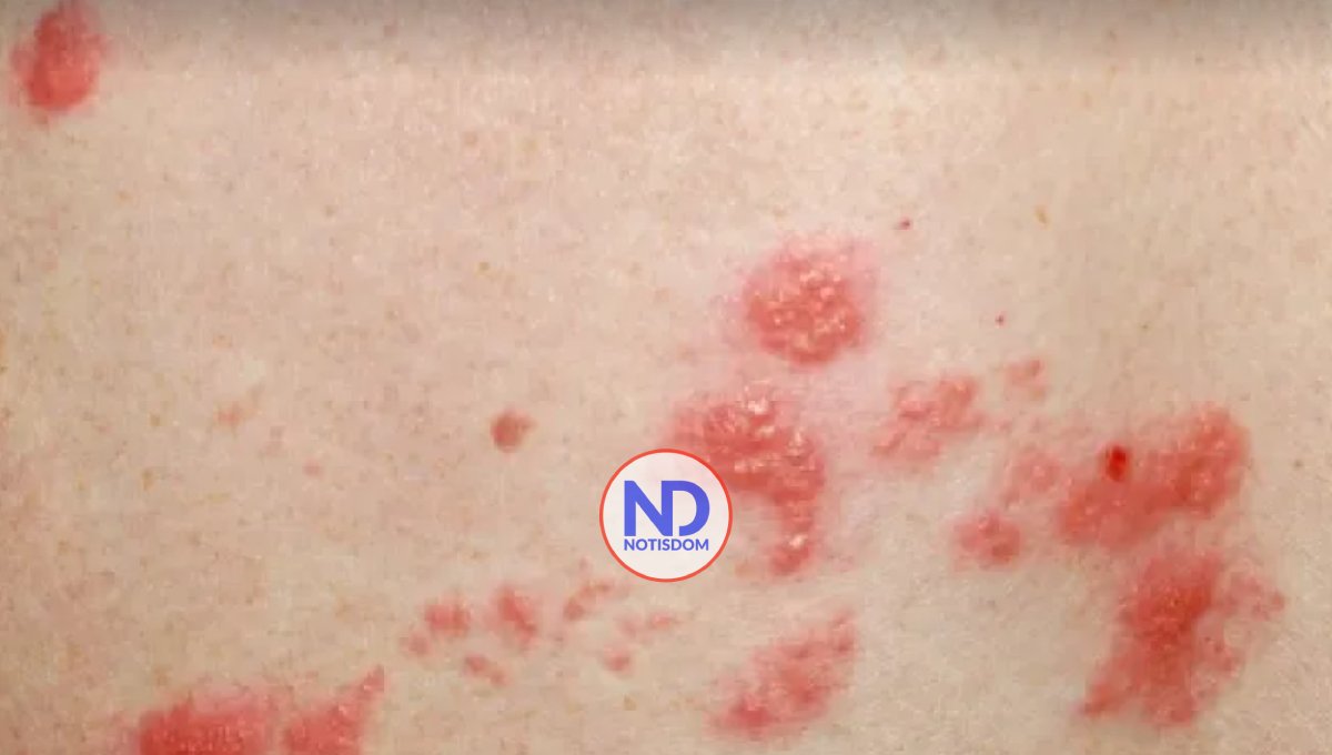 Doctora, tengo herpes simple vaginal, ¿Puedo tomar algún medicamento para prevenir los brotes?