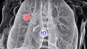 Atención tardía de cáncer de pulmón eleva muertes y costos en Latinoamérica